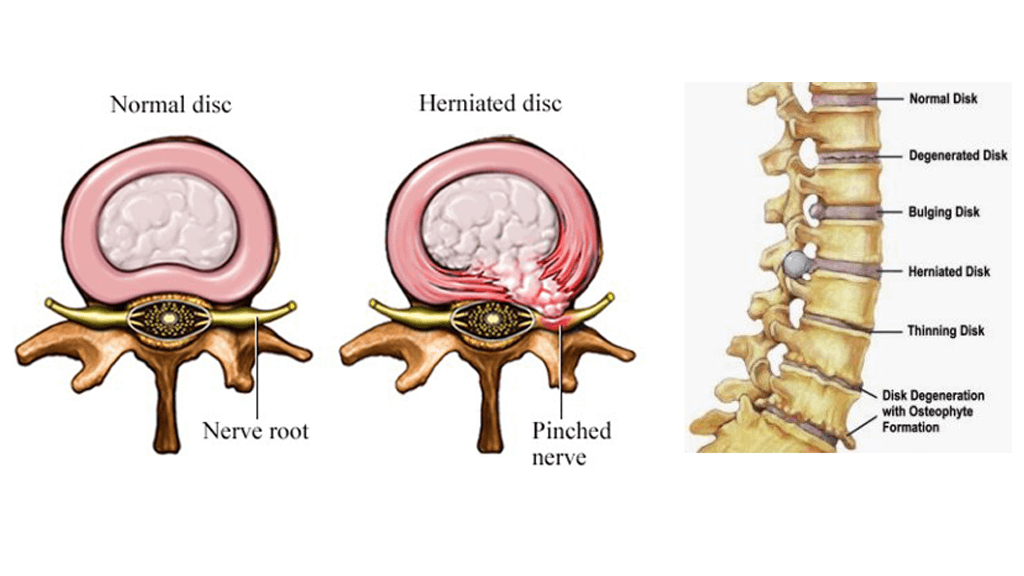 middle back pain left side