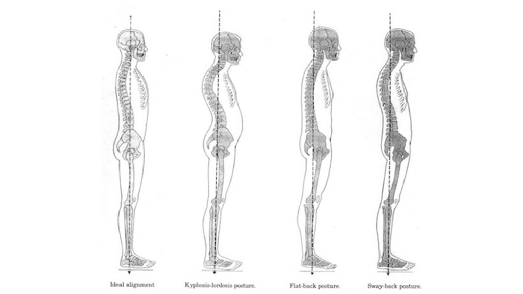 What happens when your body is out of alignment? - pilates