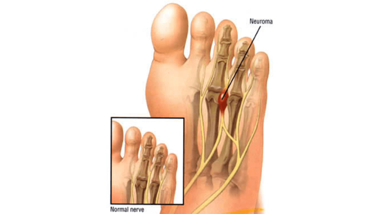 why-do-i-have-red-toes-an-overview-causes-and-prevention-feet