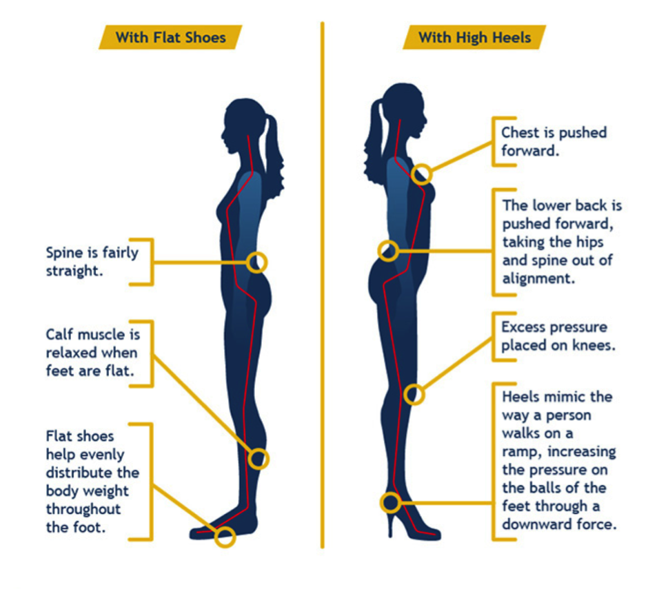 Morton's neuroma: Healing the effects of high heels